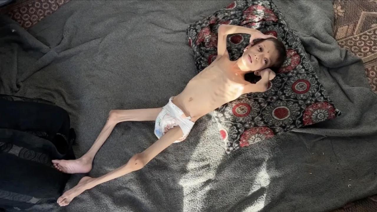 10 yasindaki gazzeli nafiz 4 aylik bebege donustu annesi tasimaya bile korkuyor uxNLMrgB